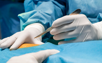 Процедура удаления Эспераль - Квинмед